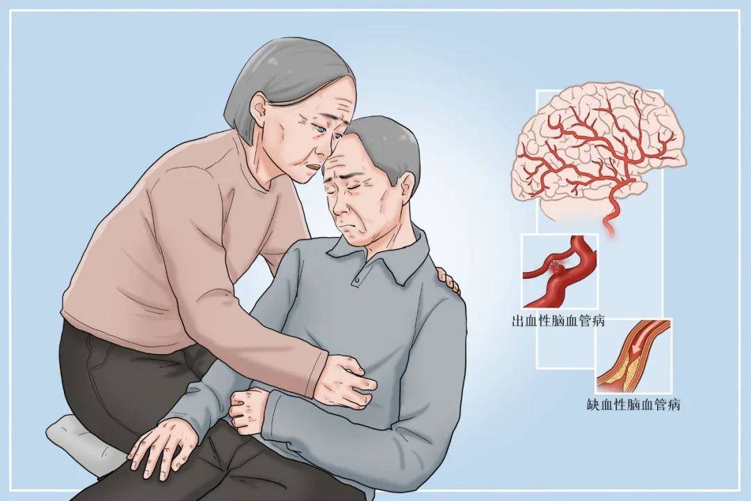 包括缺血性脑卒中和出血性脑卒中