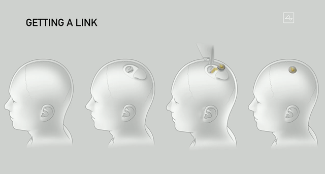 脑机设备植入流程 来源：Neuralink