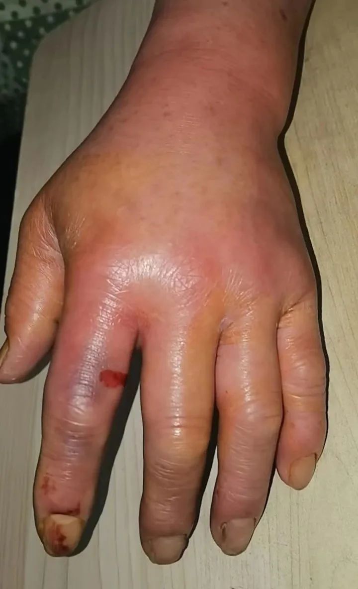 多年的大厨竟遭一条鱼"暗算"!这种感染进入好发季,有人曾截肢保命|感