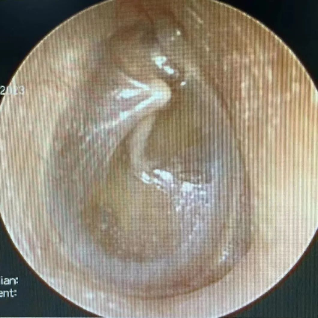 耳内镜显示：中耳里积满了黄色的液体，鼓膜明显内陷