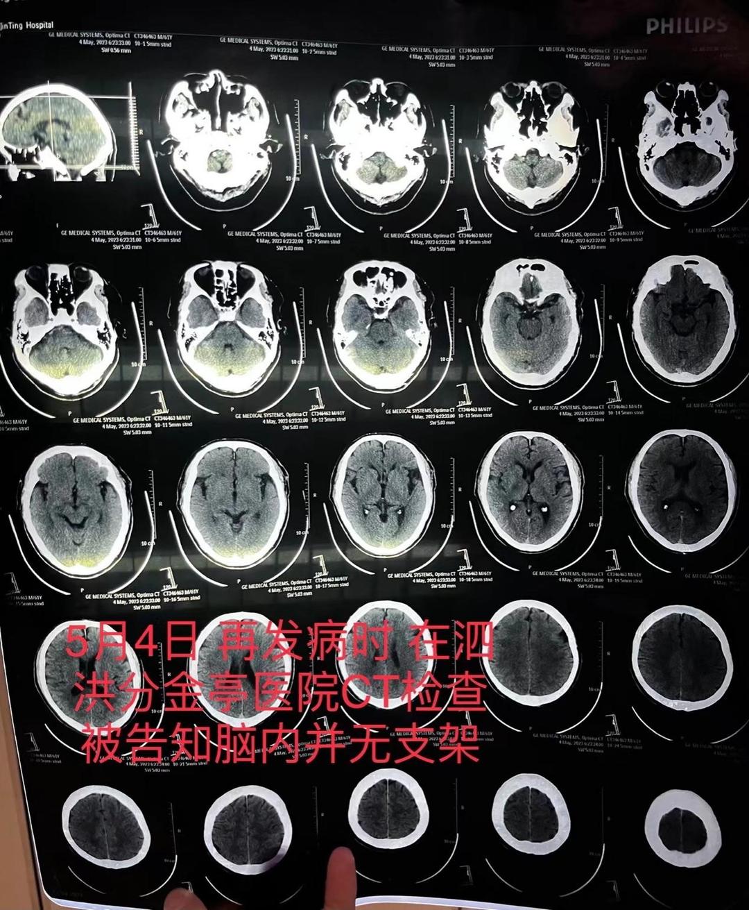↑老人在泗洪县分金亭医院的CT检查报告，显示颅内并无支架。图据澎湃新闻