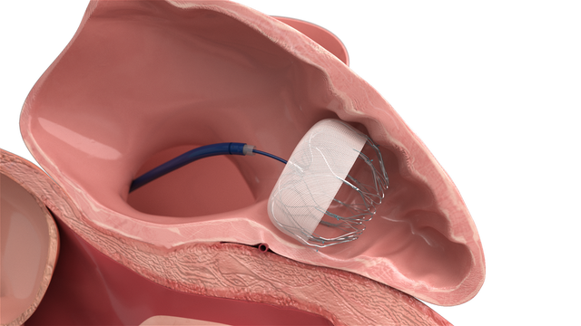 anchorman左心耳封堵器植入示意图