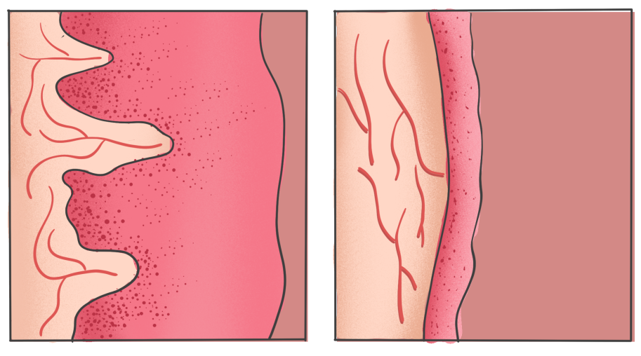 左图为正常阴道黏膜,右图为萎缩阴道黏膜