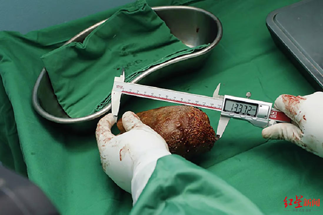 ↑军医从尼斯特·科恩格身上取出了“世界上最大的肾结石”