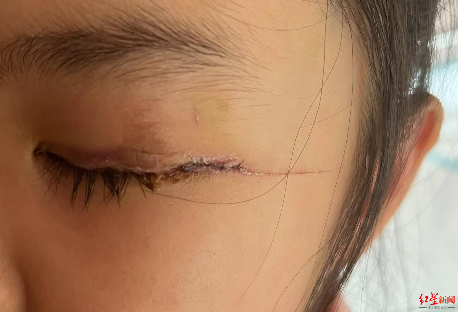 山东5岁女孩在幼儿园眼睑受伤,被发现事发时段监控缺失,教育公安部门