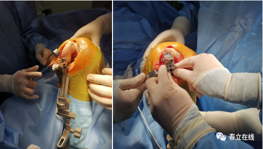 【优选病例】黑龙江省医院单髁置换手术病例分享|手术_新浪财经_新浪