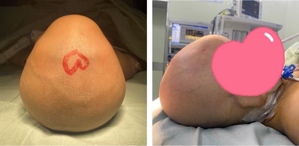 图说:术前头颅形状