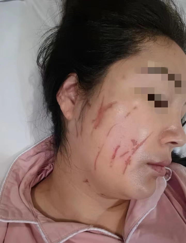 女士称自己被对方打出伤痕