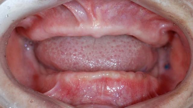 图1 无牙颌患者口内情况(左右滑动查看更多)