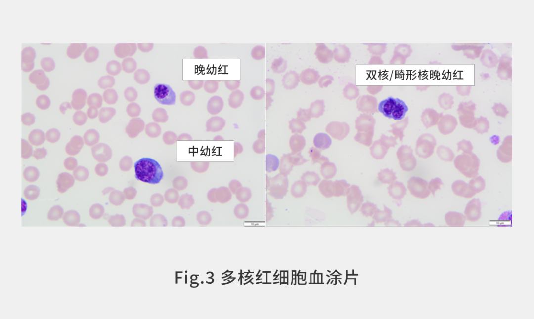 大细胞增多,中幼红细胞和晚幼红细胞常常具有多个核,可以达到2~12个