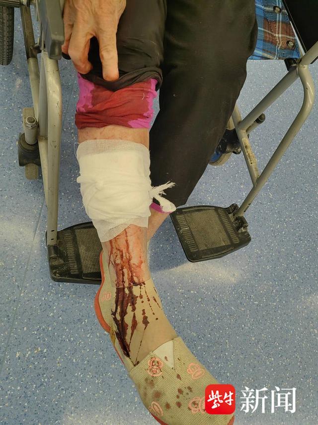 图为黄某腿部被砸伤