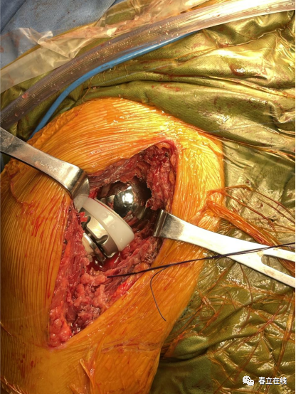 【优选病例】反置式人工全肩关节置换术病例分享