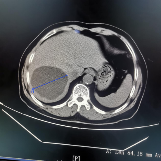 腹部ct提示巨大肝囊肿