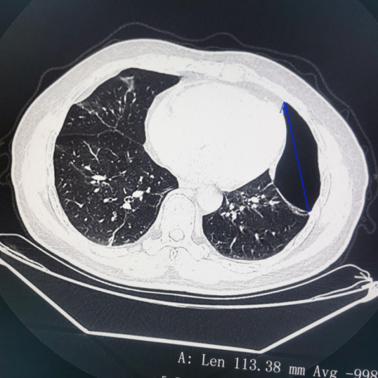 胸部ct提示左侧巨大肺大疱