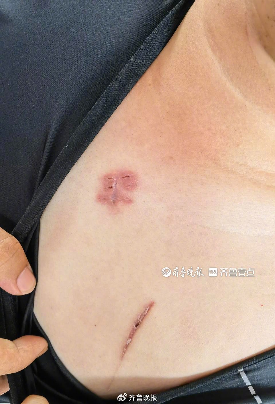 抓刀双指肌腱全断,胸口被刺差点扎心——泰安90后勇斗歹徒