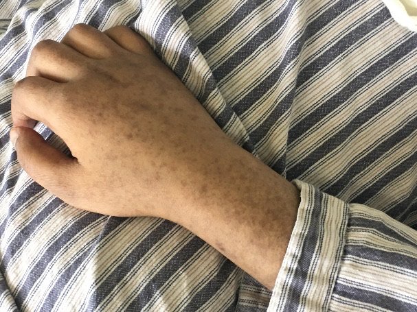 科普|多黏菌素b用了会导致皮肤色素沉着,您知道吗?