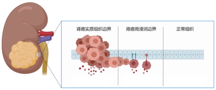 科普|前列腺癌与PSA的前世今生|前列腺癌_新浪财经_新浪网