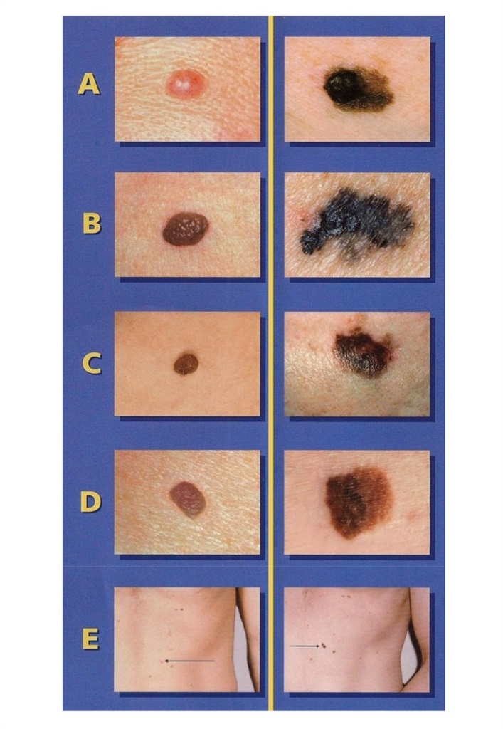 变化(evolving)外观发生变化的痣d直径(diameter)黑色素瘤一般大于5mm