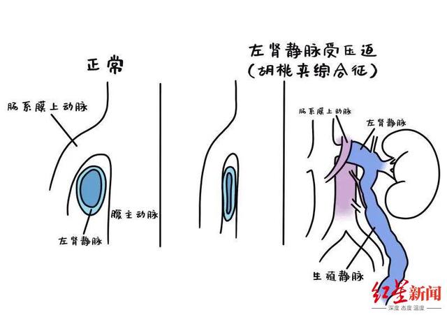 胡桃夹综合征病因示意图