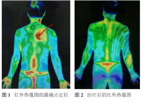 医用红外热像仪怎么开机【康复之声】评估＋治疗！红外热像技术及冲击波联合应用在肌筋膜疼痛综合征中的作用_https://www.jmylbn.com_新闻资讯_第2张