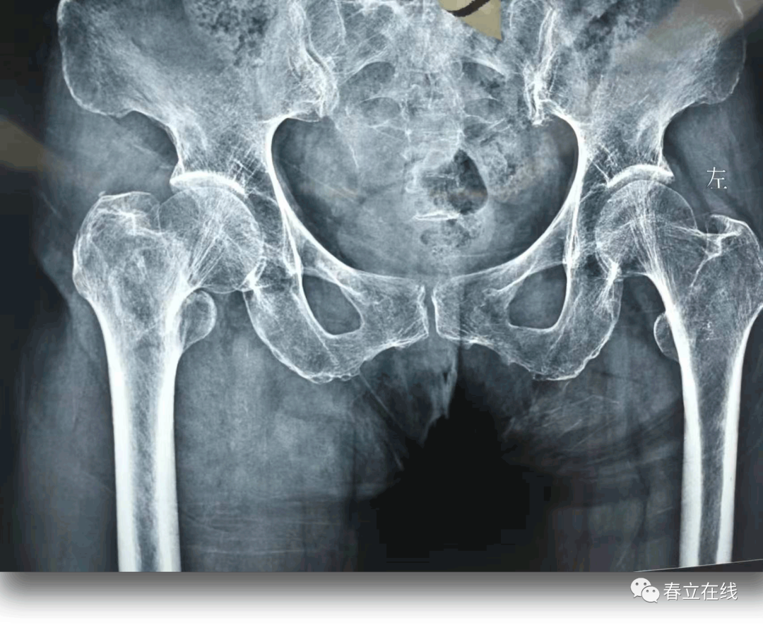 貌,右髋部轻度肿胀,腹股沟区明显压痛,可扪及明确的骨擦感及反常活动