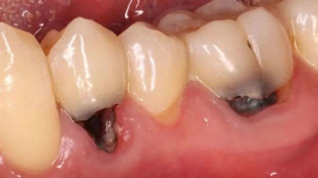 预防根面龋可采取局部用氟方法,如使用含氟牙膏刷牙,定期到医院接受