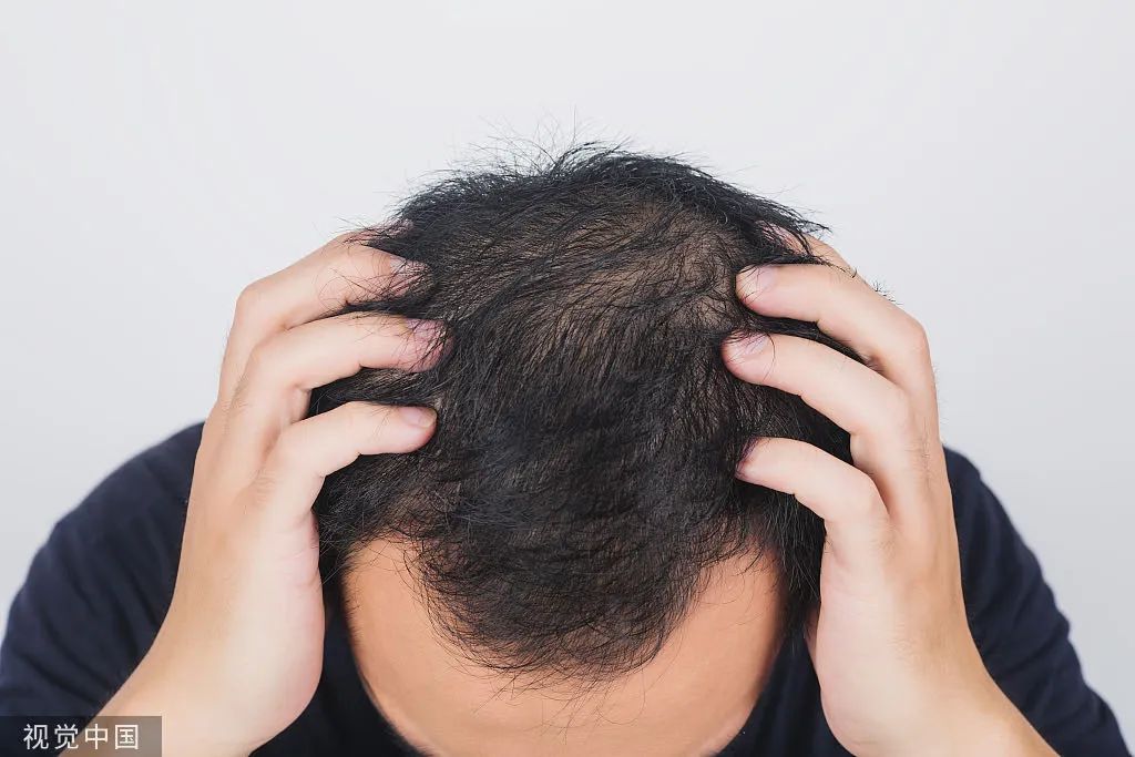 被脱发困扰的年轻人 图/视觉中国