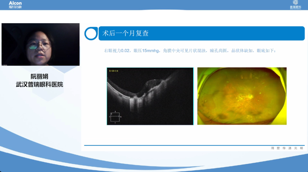 拨云清雾,探其真目!爱尔康-普瑞眼科眼底病学组疑难病例讨论会召开