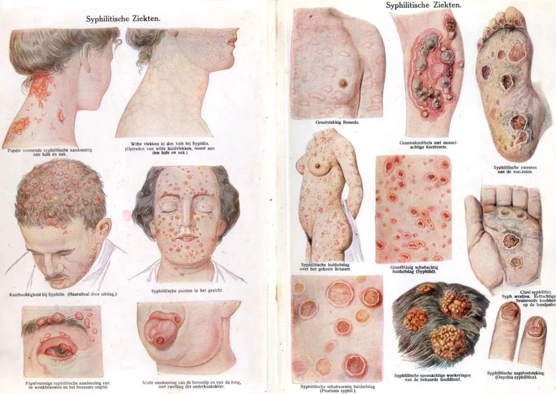 第二期梅毒,图片来源:wikipedia