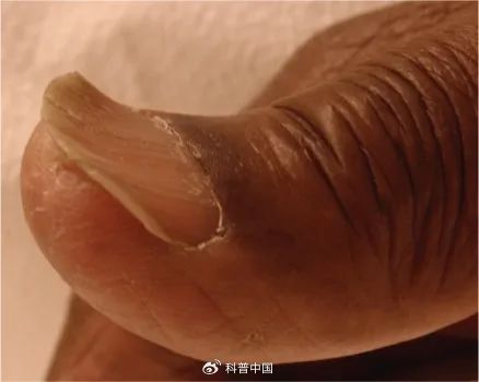 匙状甲.图片来源:参考文献[6]