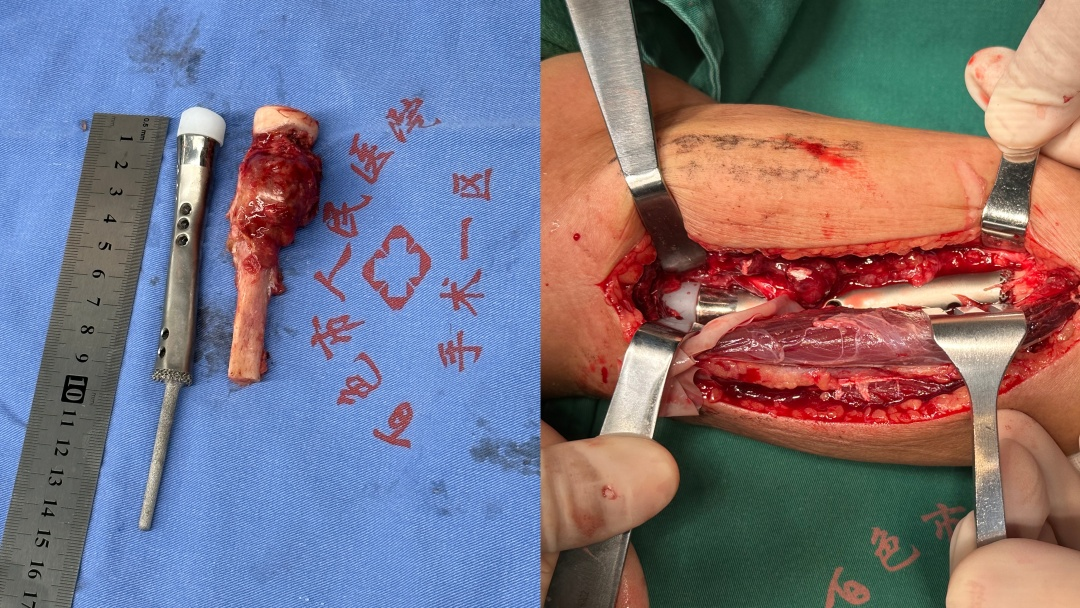 百色市人民医院首例肘关节骨肿瘤定制假体置换手术获得成功|手术_新浪