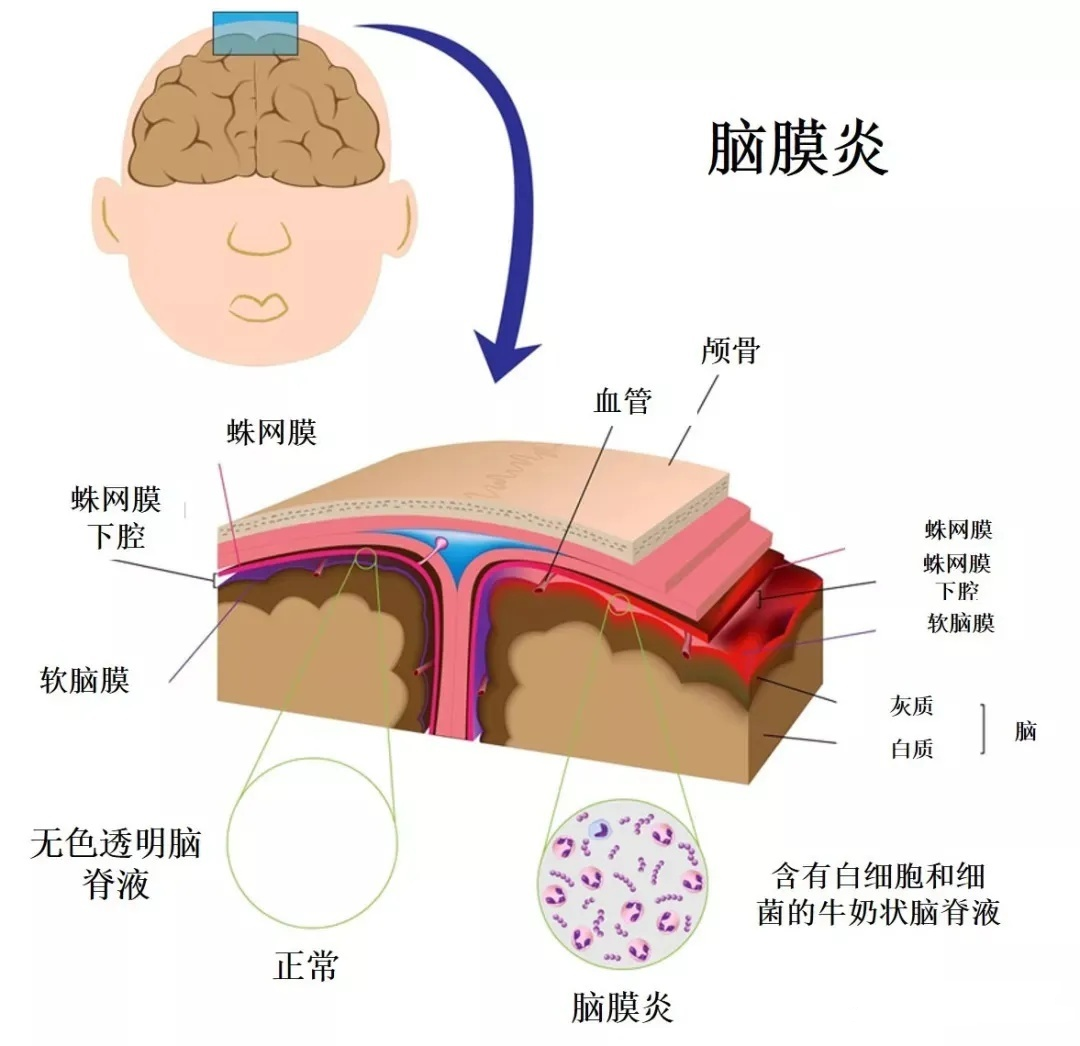脑膜炎的病理图示(图源:网络)