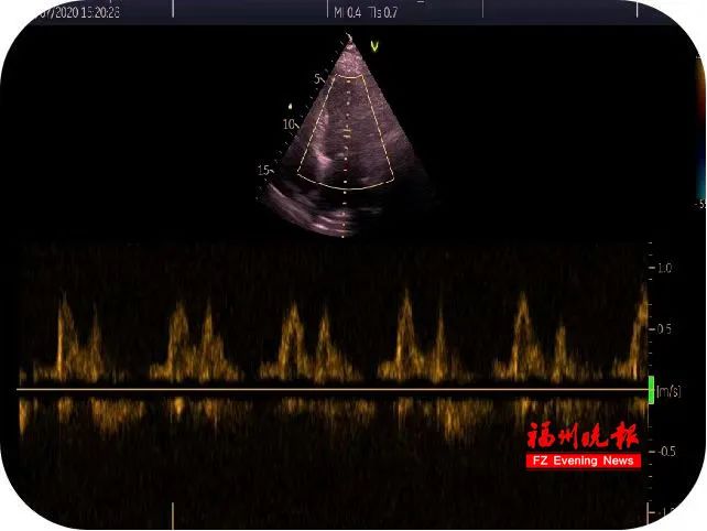 心脏彩超显示,小张的心脏左心室肥厚.受访医院供图