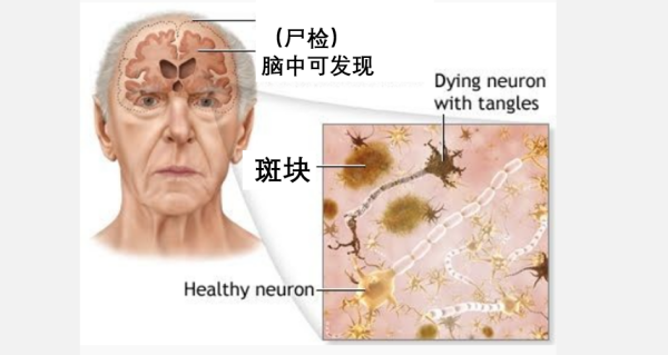 淀粉样蛋白形成的斑块。本文作者供图