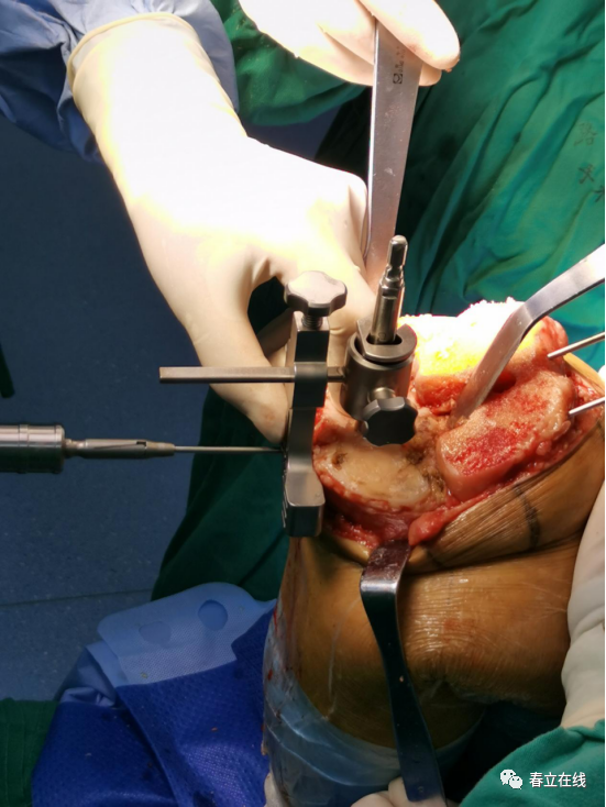 【优选病例】人工全膝关节置换术病例分享