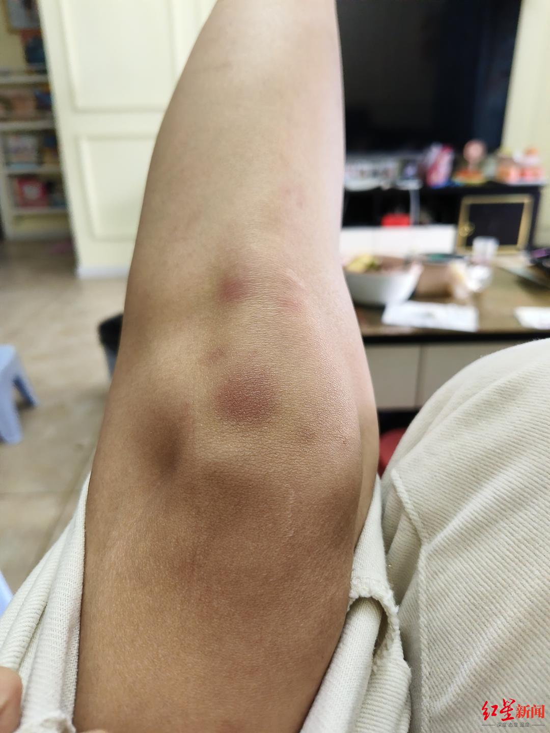 救人次日,刘婉的膝盖一片淤青