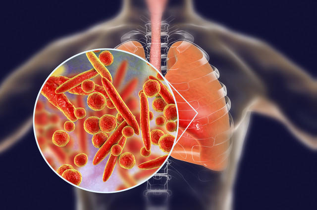 肺炎支原体感染“大年”来了？专家解析如何预防和治疗