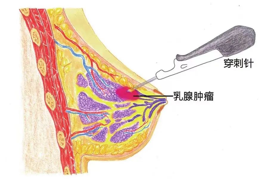 做手术台病床为什么她26岁确诊这一癌症，年轻女孩也要小心_https://www.jmylbn.com_新闻资讯_第3张