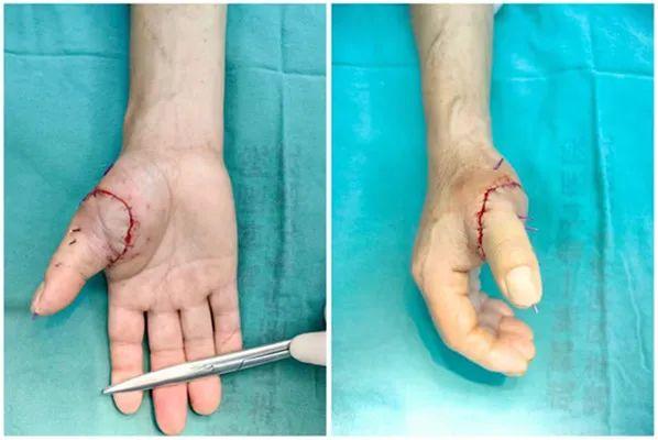 伤者手术后的手部情况