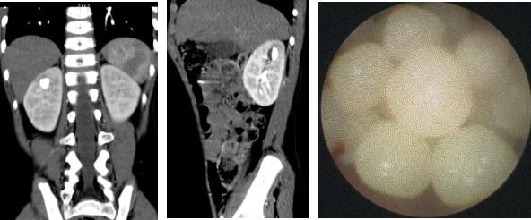 病例2:6岁男孩,马蹄肾,左肾盂及中下盏内结石,采用4.