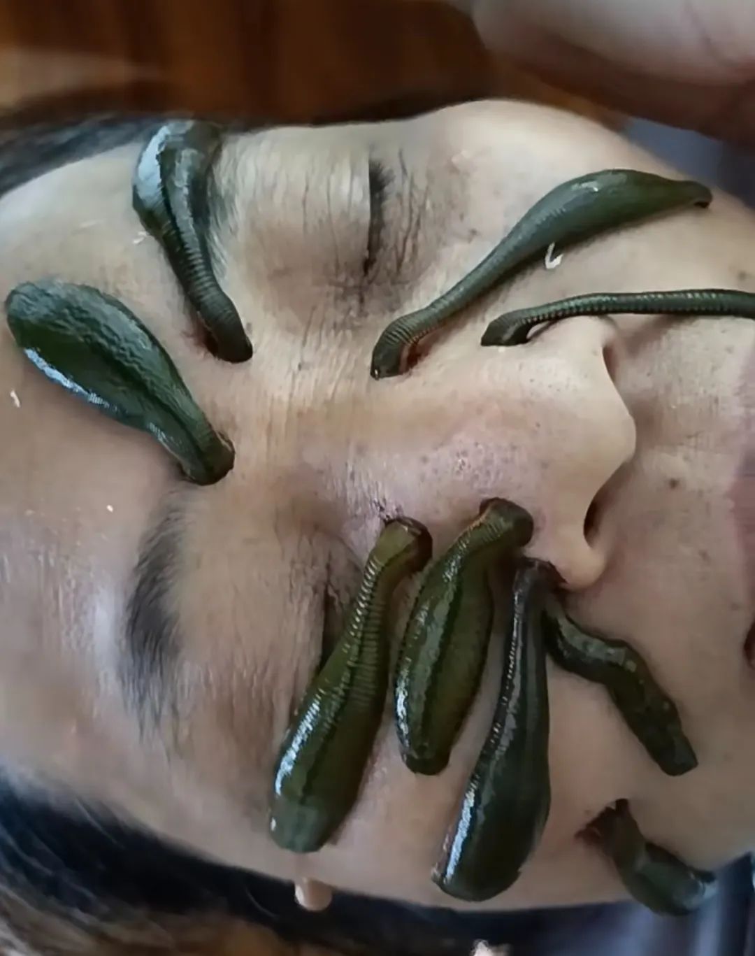 试过水蛭疗法,才知道什么是真正的噩梦