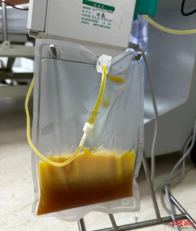 外卖,火锅,夜宵长期"炫",90后小伙血液里抽出500ml"油"!医生提醒→|外