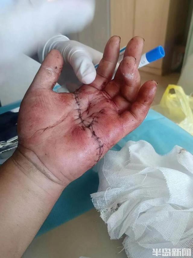 王玉桥救下了其中一名受害人,这名受害人的手被歹徒划伤(受访者供图)