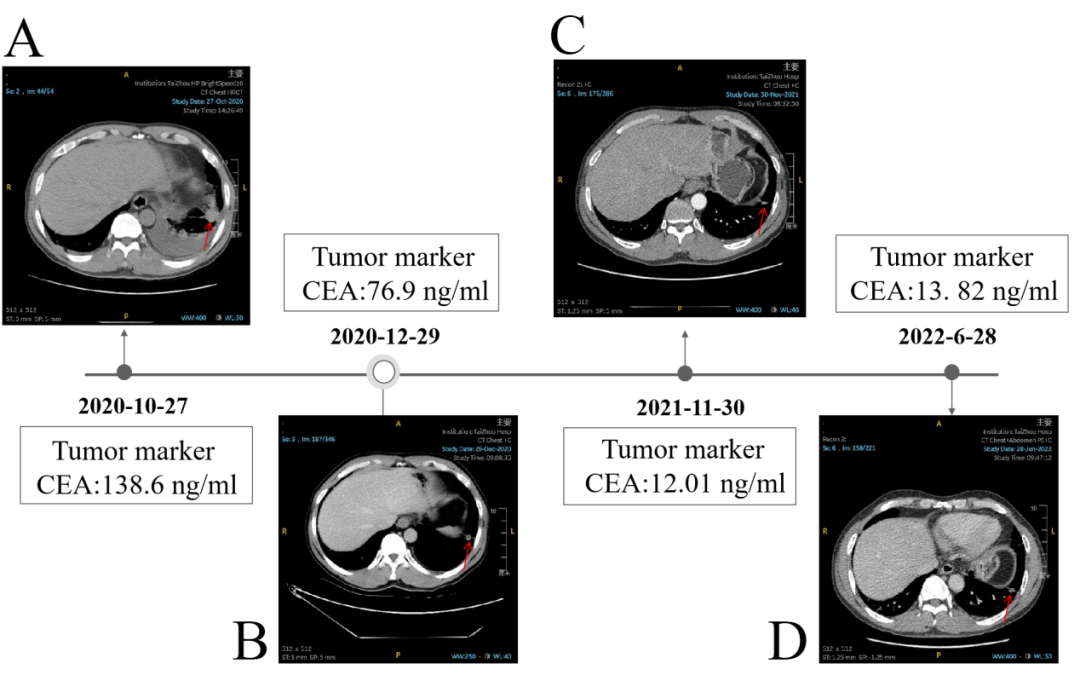 图1&nbsp; 病例1患者临床治疗时间线