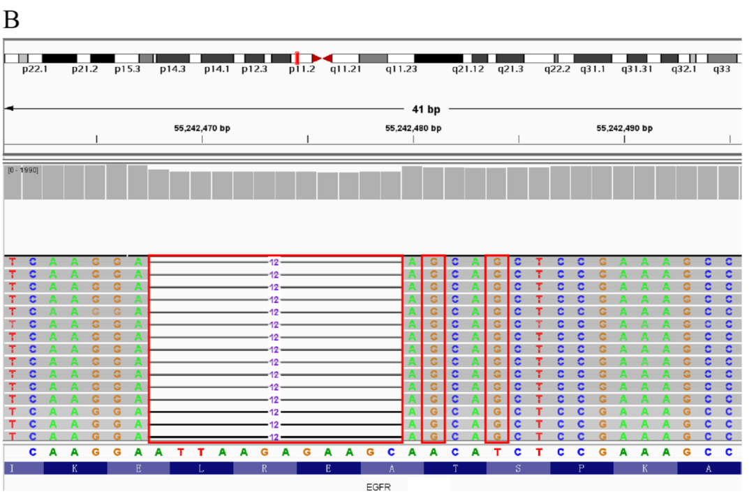 图4&nbsp; 病例3患者基因突变的ngs测序结果