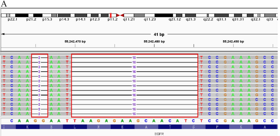 图2&nbsp; 病例1患者基因突变的ngs测序结果