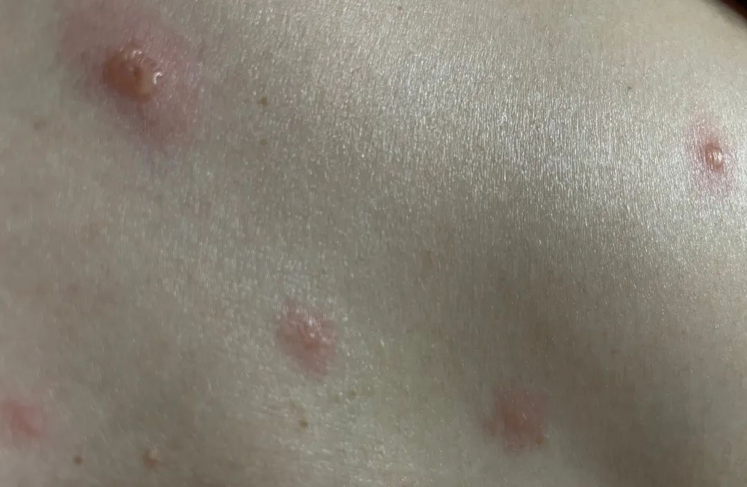 水痘.受访者供图