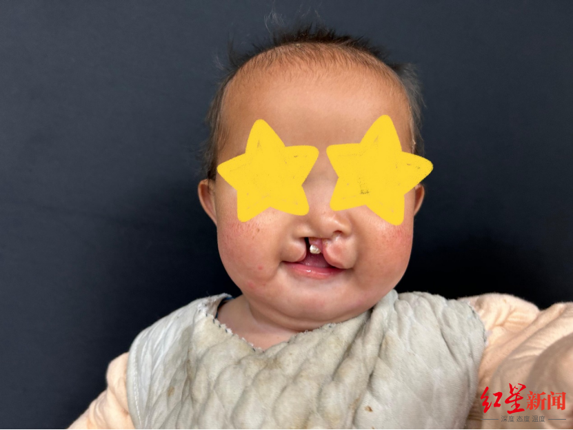 “华西”8月龄女婴严重唇腭裂影响进食，看华西专家如何妙手重塑“微笑”