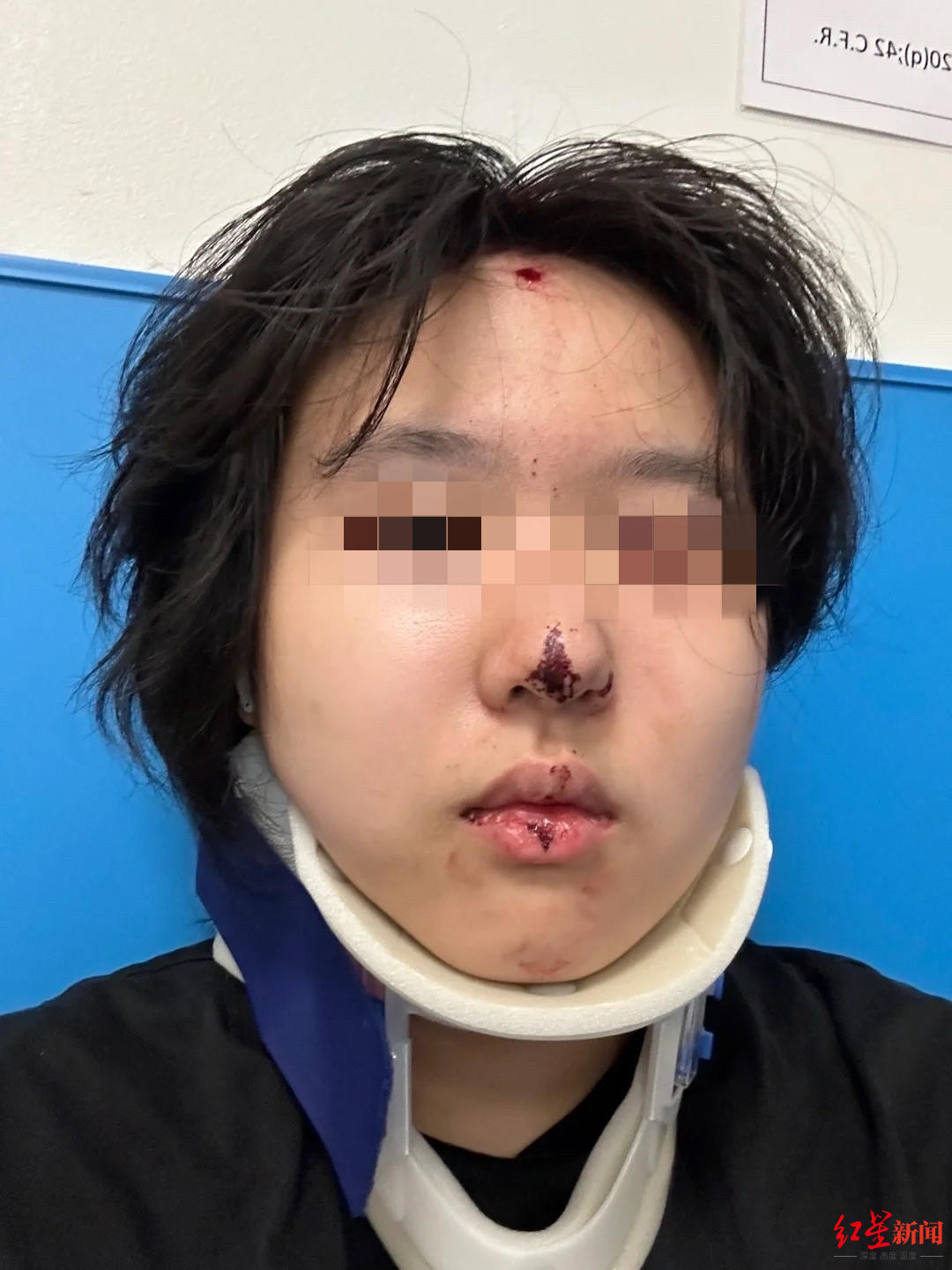 "邹某分享说,"被弹珠枪爆头了,但幸好弹珠枪子弹击中的是额头最硬的