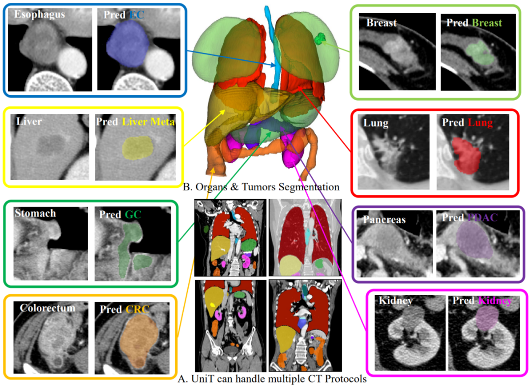 达摩院的ai研究,让人类首次实现了大规模胰腺癌早筛|胰腺癌|癌症|ct